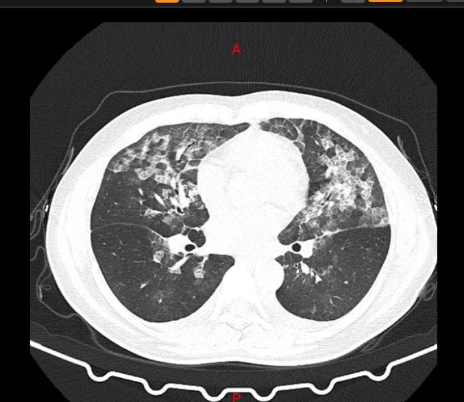 新冠肺炎的ct图片肺部图片