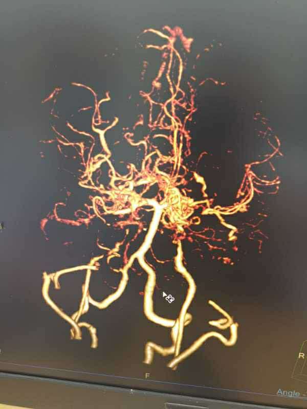 烟雾病患者脑血管造影