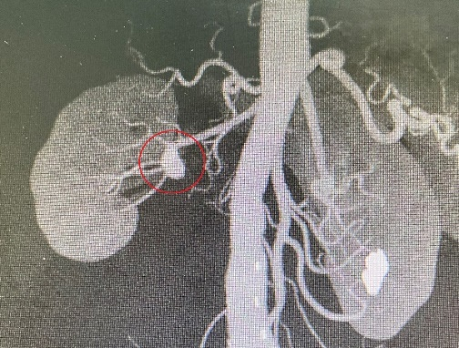 动静脉内瘘假性动脉瘤图片