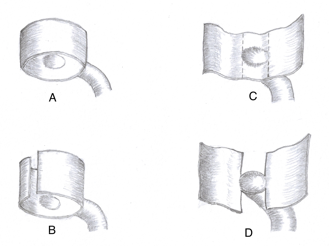 全球独创！“拼接”主动脉，医生创新术式治疗罕见心血管病患者